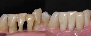 Bonding Lower Teeth