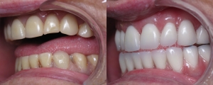 Replacing Unattractive Dentures