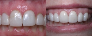 Replacing Old Veneers