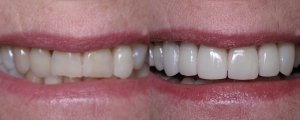 Veneers and Crowns