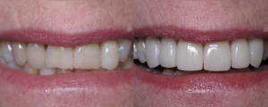 Veneers and Crowns