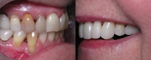 Veneers and Crowns