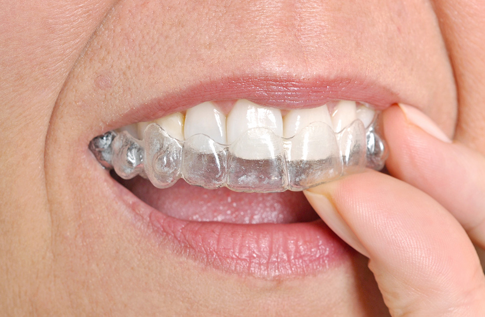 Tooth Restoration &amp; Enhancement Brunswick OH | Dr. Lisa Elias - invisalignBraces
