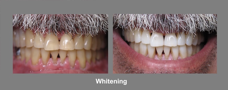 Teeth Whitening Brunswick OH: Restorative Dentistry | Dr. Lisa Elias - whitening